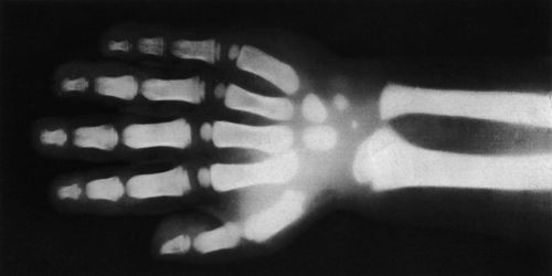 X-rays or Röntgen Rays
