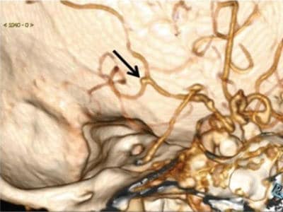 AI Helps Detect Brain Aneurysms On CT Angiography 1
