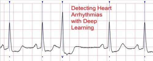 detect the Most Common Cardiac Arrhythmia 1