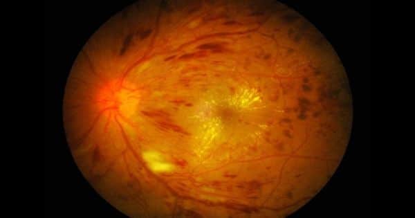 Researchers identified genes to classify diabetic retinopathy factors