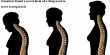 Scientists found a novel form of a drug used to treat osteoporosis