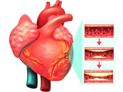 Skin may help to predict heart disease 1