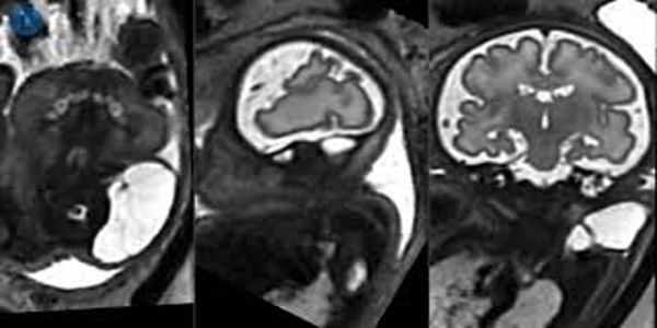 MRI-imaging-can-more-precisely-reveal-abnormalities-in-unborn-babies-1
