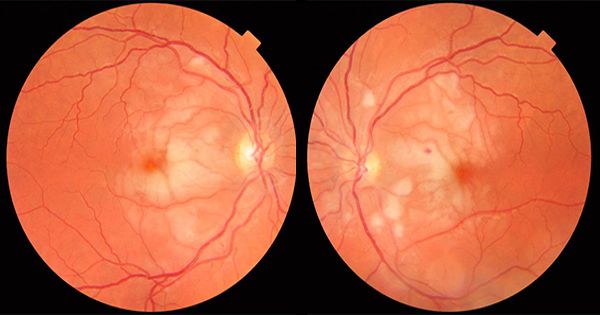 Scientists-determined-a-simple-eye-exam-to-Early-Parkinsons-Disease-Diagnosis-1