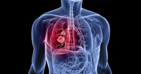 Scientists evaluated facts to assess of harms and benefits of lung cancer screening