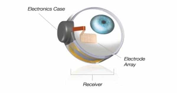 Engineers-is-developing-a-retinal-implant-that-could-moderately-restore-vision-in-blind-people-1