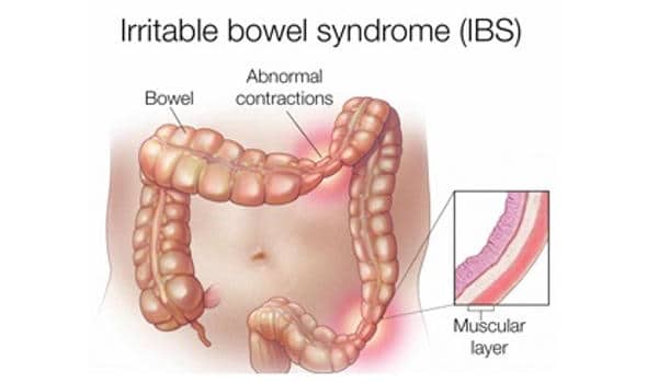 Researchers-identified-the-biological-mechanism-that-explains-irritable-bowel-syndrome-1