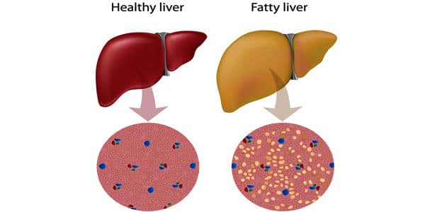 Exercise-Regimen-Reduces-Liver-Steatosis-and-Stiffness-in-Patients-1