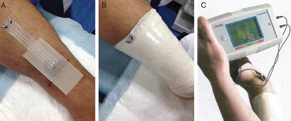 Researchers-developed-Smart-Wound-Dressings-with-Built-in-Healing-Nanosensors-1