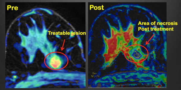 High-intensity-Focused-Ultrasound-is-used-to-develop-new-Cancer-Treatments-1