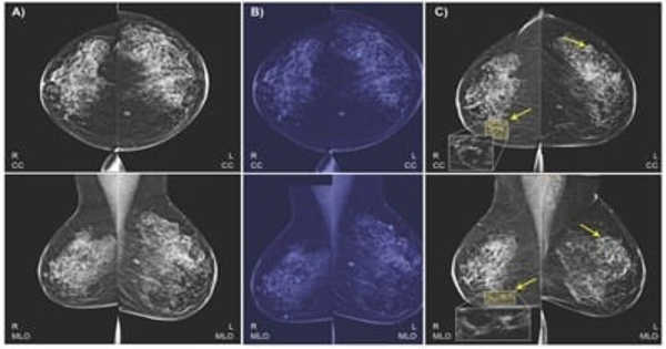 In MRI Breast Cancer Screening, Prediction Models could Reduce False Positives