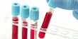 A New Test for Detecting Depression in Blood Samples has been developed