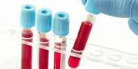 A New Test for Detecting Depression in Blood Samples has been developed