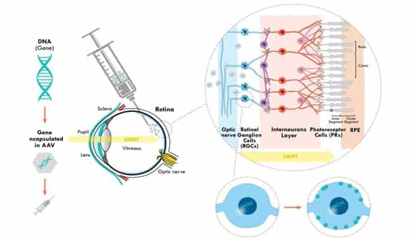 Blind-Patients-Vision-is-Restored-after-Gene-Therapy-is-Injected-into-the-Eyeball-1