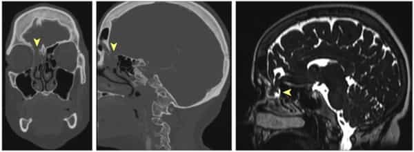 For-Nine-Months-a-COVID-Test-caused-a-Mans-Brain-to-Leak-Cerebrospinal-Fluid-1