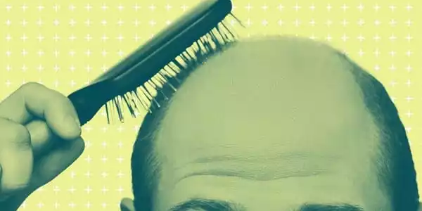 A-New-Genetic-Discovery-may-Lastly-Clarify-Baldness-1