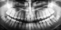 A New Treatment Stimulates the Growth of New Teeth