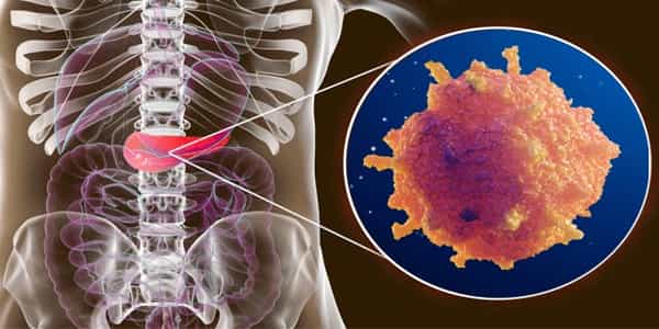 Pancreatic-Cancer-Treatment-may-be-improved-by-using-Lab-grown-Tumor-Models-1