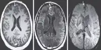 The Discovery of a Tapeworm inside a Man’s Brain has Doctors Concerned