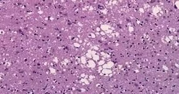 In Prion Diseases, how do Brain Cells Die?