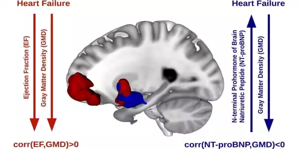 Early-Brain-Dysfunction-is-caused-by-Heart-Disease-and-shown-crucial-Alzheimers-Protein-1