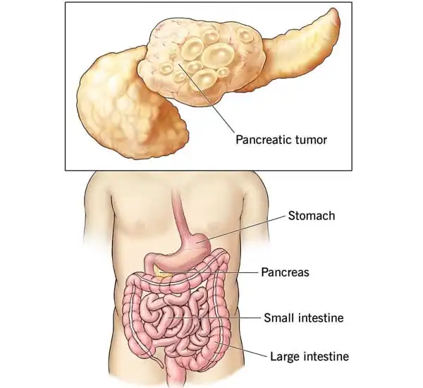 Immune-Suppression-in-Pancreatic-Cancer-is-connected-to-Gut-Microorganisms-1