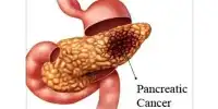 Immune Suppression in Pancreatic Cancer is connected to Gut Microorganisms