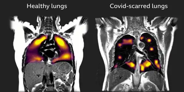 Prolonged-Inflammation-has-been-related-to-Post-COVID-Lung-Issues-1