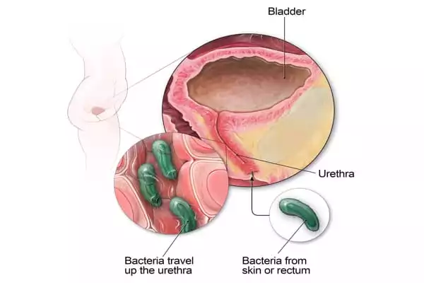 Urinary-Tract-Infections-What-You-Should-Know-1