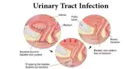 Urinary Tract Infections: What You Should Know