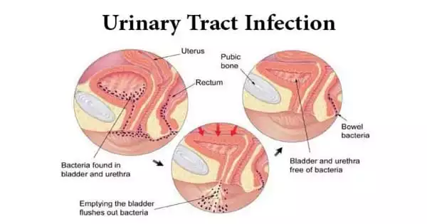 Urinary Tract Infections: What You Should Know