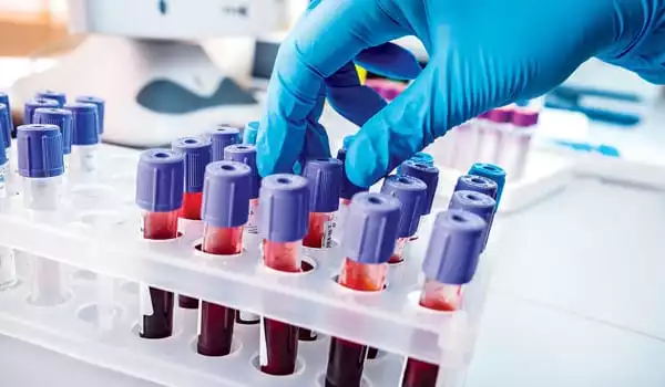 A-Blood-Test-as-a-Potential-Diagnostic-Tool-for-Alzheimers-Disease-1
