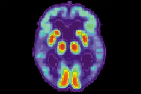 A-New-Imaging-Scan-Reveals-a-Possible-Cause-of-Alzheimers-Cognitive-Loss-1