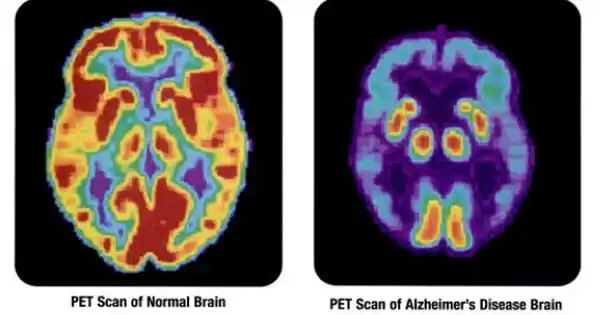 A New Imaging Scan Reveals a Possible Cause of Alzheimer’s Cognitive Loss