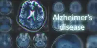 Development of Human Olfactory Mucosa Cell Model Sheds Light on Alzheimer’s Disease