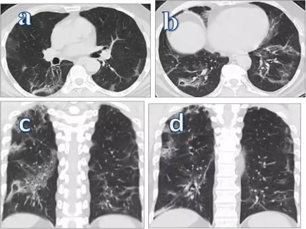 Keeping-COVID-Patients-Long-term-Lung-Damage-to-Minimum-1