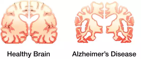 In Mice, a New Method Minimizes Brain Damage in Alzheimer Illnesses ...