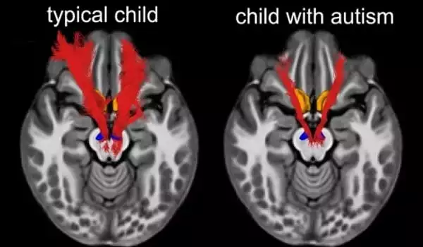 Scientists-discover-that-Newborns-with-Autism-have-an-Expansion-of-Critical-Brain-Structure-1