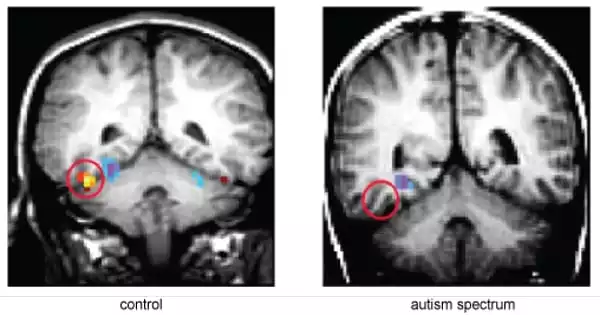 Scientists discover that Newborns with Autism have an Expansion of Critical Brain Structure
