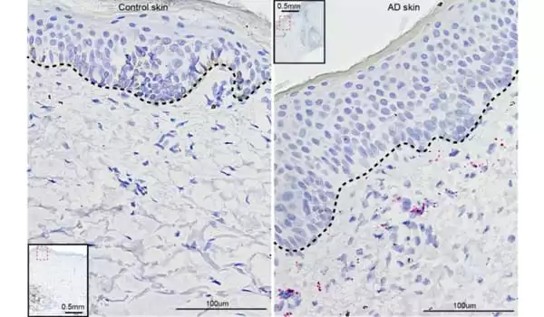 A-Coincidental-Discovery-Sheds-Light-on-how-Eczema-Develops-1