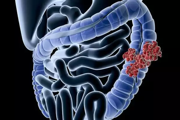 Exercise-Shown-to-Reduce-the-Risk-of-Bowel-Cancer-by-Releasing-Protein-1