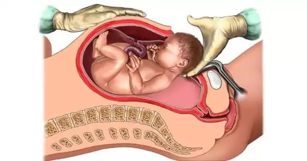 Response to an Emergency Caesarean Placenta