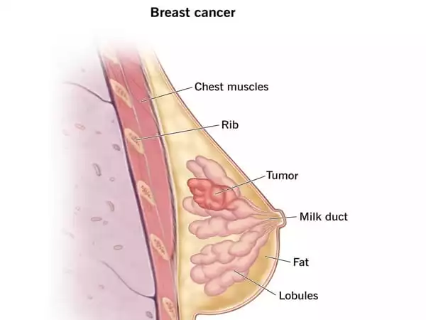 Salt-in-Tumors-may-aid-in-the-Diagnosis-and-Treatment-of-Breast-Cancer-1