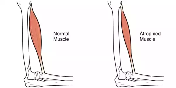 Several-Treatments-are-Available-to-Reduce-Age-related-Muscle-Loss-1