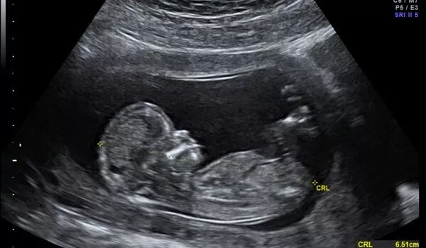 AI-based-Fetal-Ultrasound-Birth-Defect-Detection-1