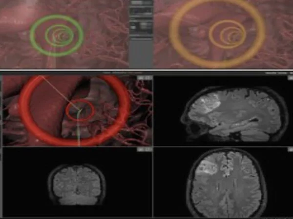 A-Minimally-Invasive-Robot-places-a-new-Flexible-Steerable-Device-in-Live-Brains-1