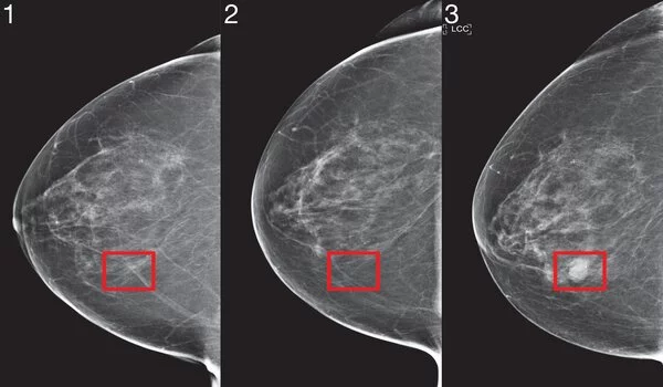 AI can predict the effectiveness of breast cancer chemotherapy