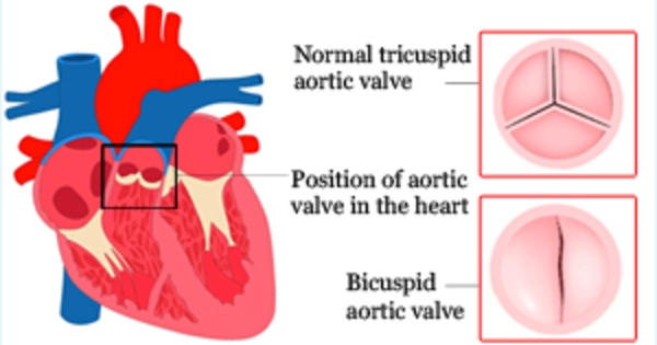 Heart valve disease linked to serotonin