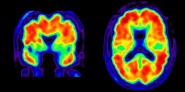Artificial intelligence approach may help detect Alzheimer's disease from routine brain imaging tests