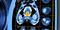 For Patients with Prostate Cancer, MRI-guided Radiotherapy results in fewer side effects and Higher Quality of Life